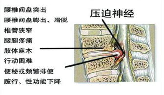 腰椎旁的肌肉贴怎么贴 腰椎旁的肌肉贴怎么贴图片