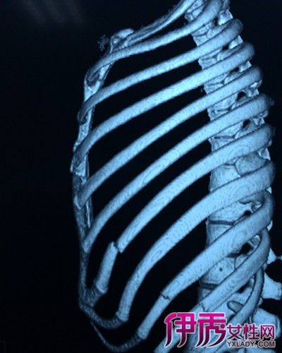 什么是陈旧性肋骨骨折 陈旧性肋骨骨折影像学表现